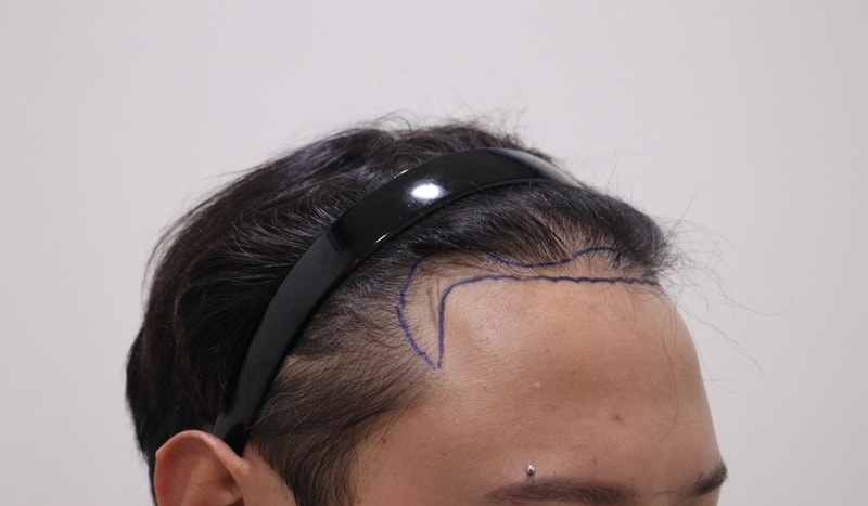 1. 수술전_3.JPG