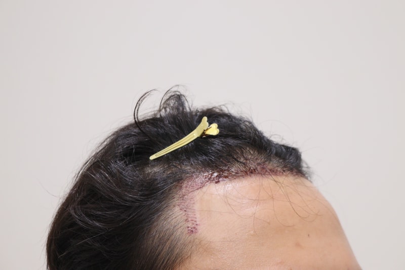 2. 수술후_1일_3.JPG