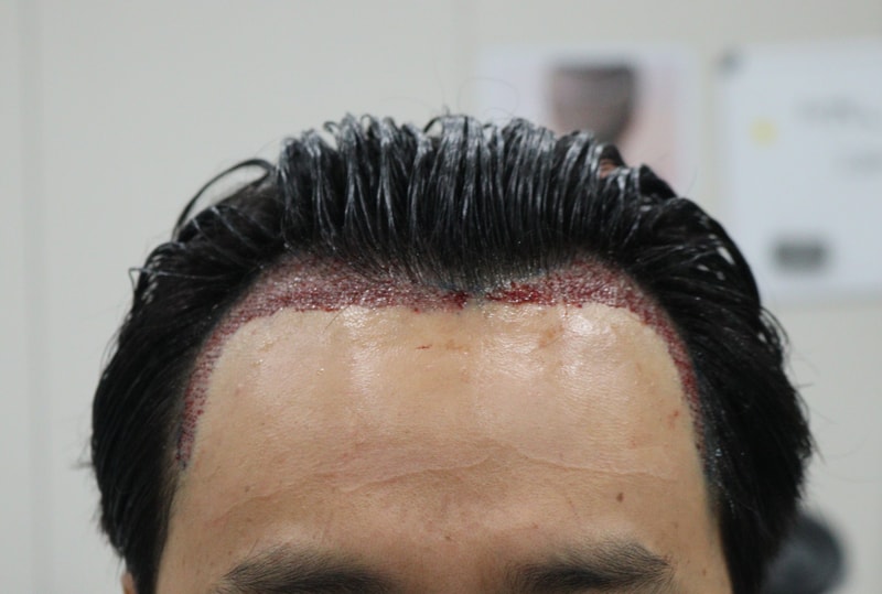 2. 수술후_당일_1.JPG