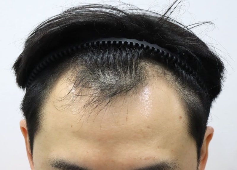 2.수술전.JPG