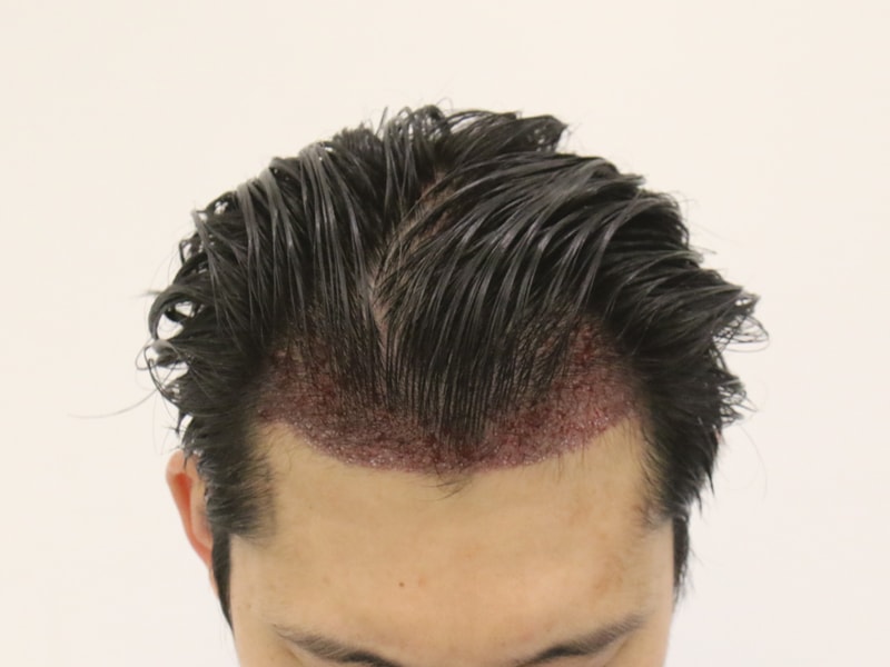 수술후_2.JPG