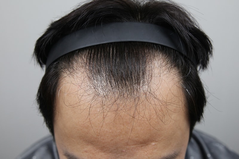 깊은 M자. 김대우 원장과 상담 후 확신을 얻고 이식했습니다.