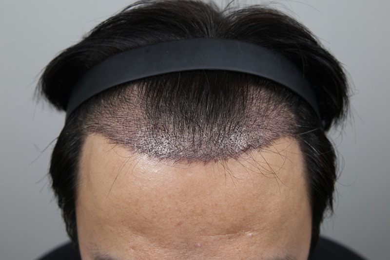 깊은-M자-김대우-원장님의-섬세함으로-확신을-얻고-이식했습니다-(5).jpg