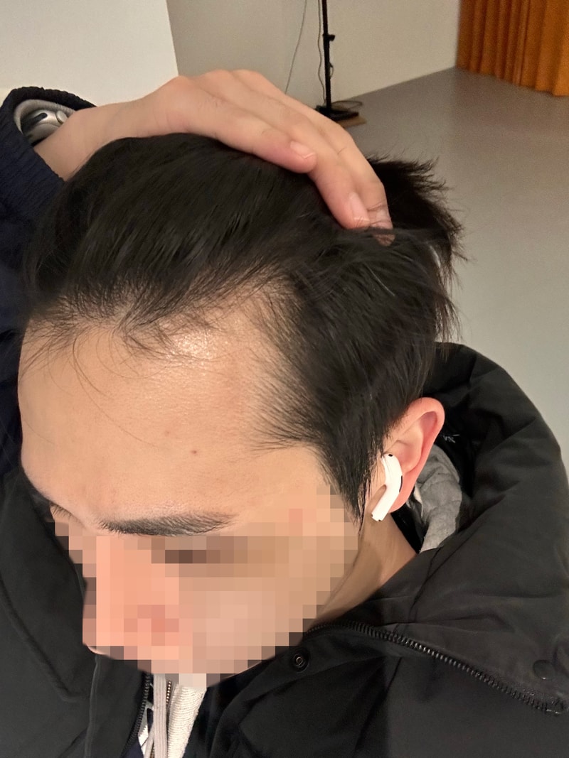 엠자이마 무삭발 헤어라인 모발이식 10일차 모원성형외과 정재홍원장님