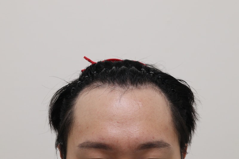 비절개 모발이식 6개월차 후기남깁니다