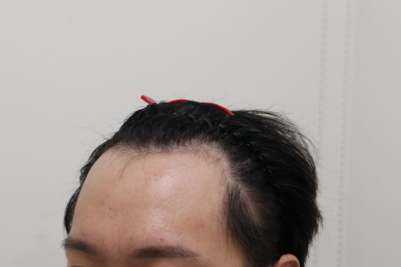 1. 수술전_2.JPG