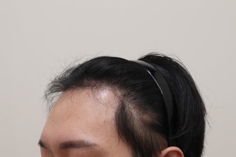 3. 수술후_6개월_2.JPG