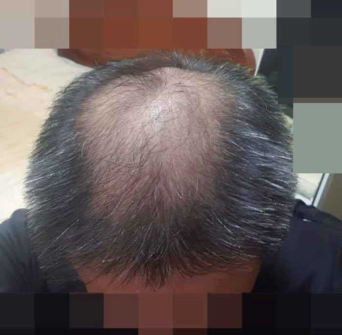 모발이식전.jpg