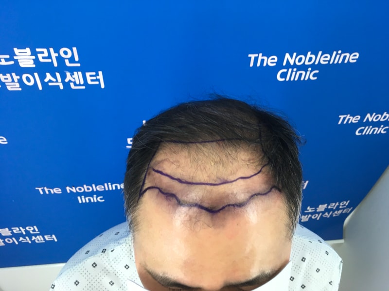 3552모낭 8611모 이식 완료