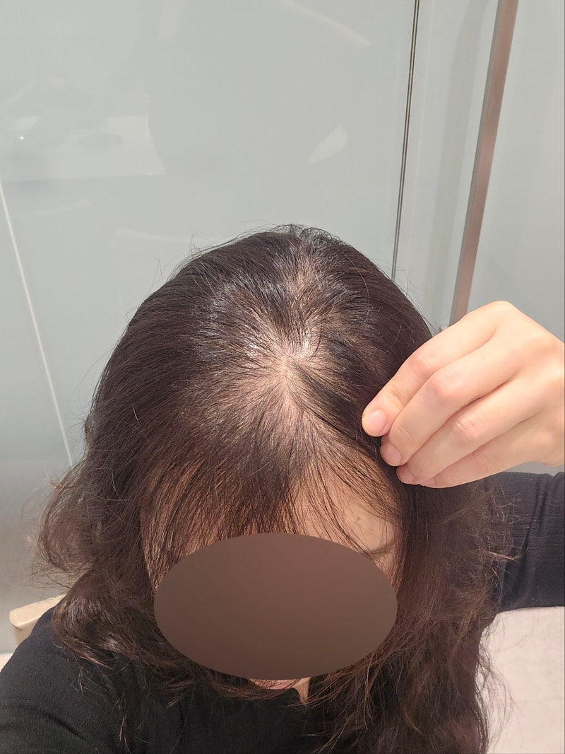 모원성형외과 헤어라인+전두부 무삭발 모발이식 1500모낭 3개월
