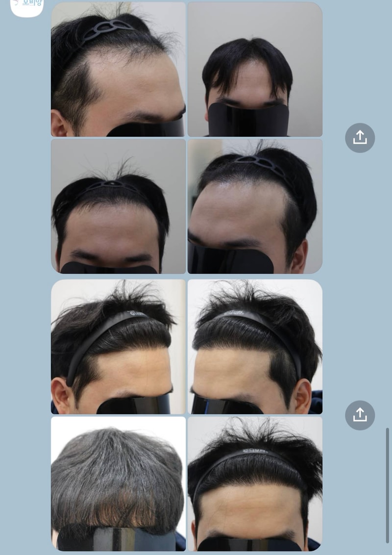 After 1 year and 2 months of Hair Transplant of Gwangju Apgujeong Mobiang Clinic