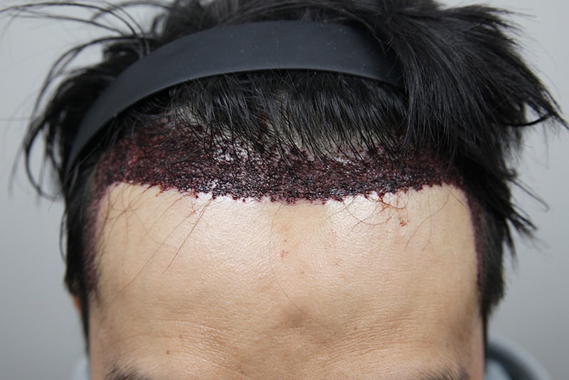 수술후1일.jpg