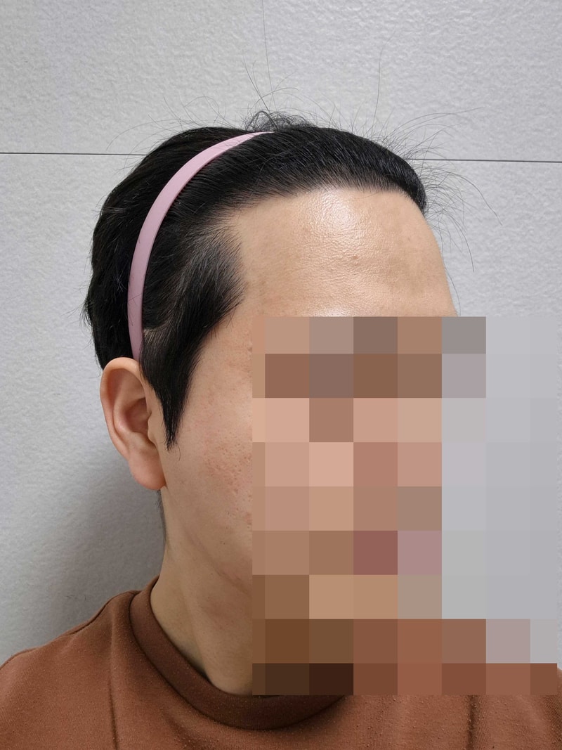 다나성형외과 비절개모발이식 2400모 17개월 - 수술선택, 변화, 조언