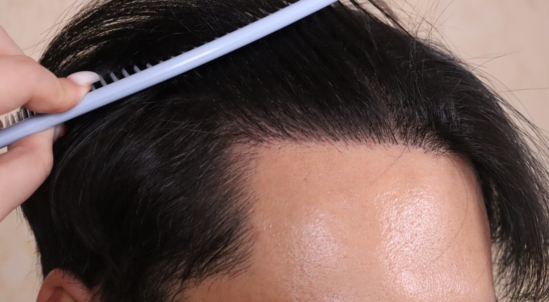 Day 280 of Umchan's Hair Transplant surgery.