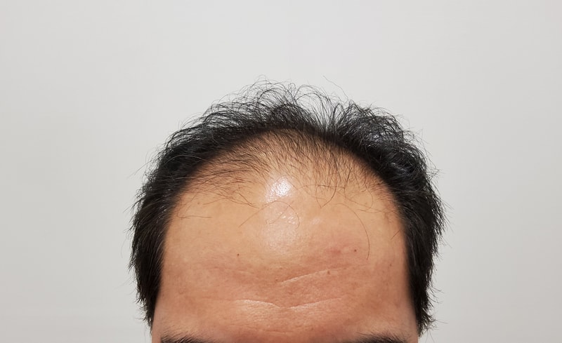 삭발하고 수술흉터랑 M자, 헤어라인이식한지 3개월 지났습니다