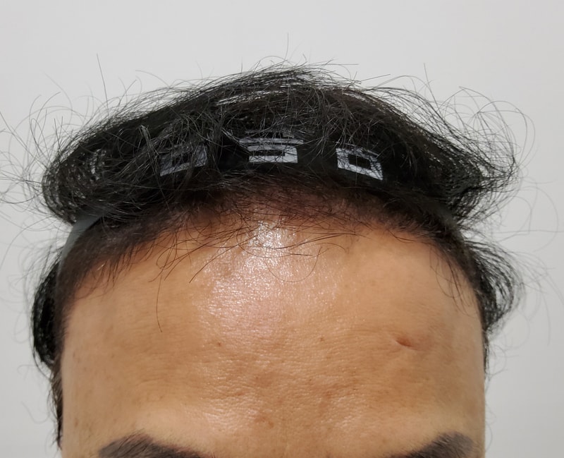 3. 수술후_3개월_1.jpg