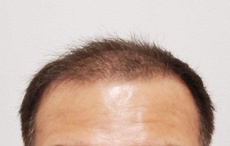 3. 수술후_3개월_1.jpg