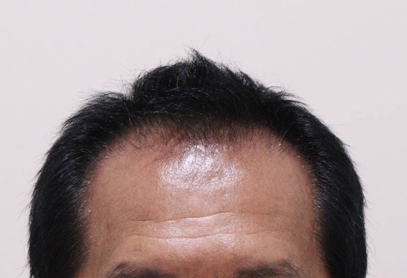 3. 수술후_3개월_1.JPG
