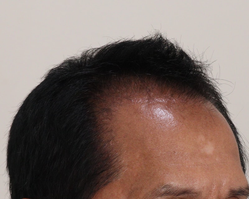 3. 수술후_3개월_3.JPG