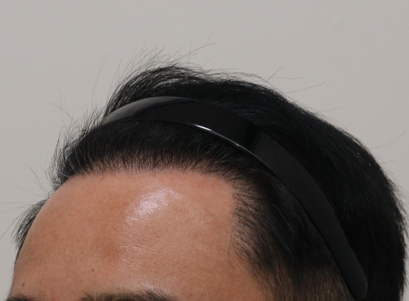 3. 수술후_6개월_2.JPG