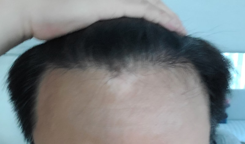 It's already been 6 months since the Hair Transplant.