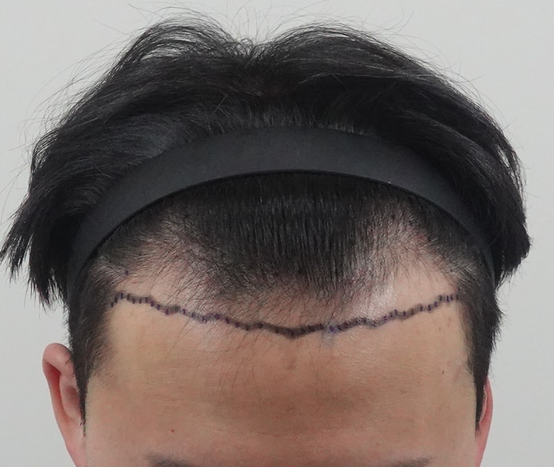 모발이식 절개+비절개 3800모_김용빈원장님