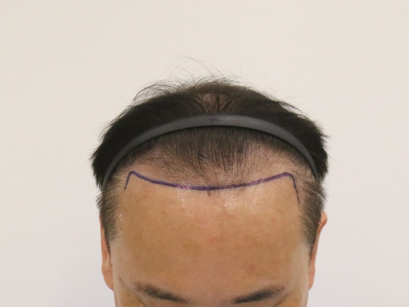 드디어 저도 4개월이 되었습니다 부산 맘모스 모발이식한지!