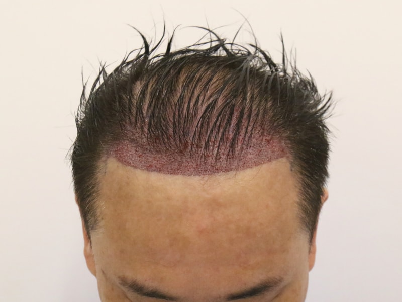 수술 후.JPG