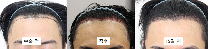 신사★모프로의원,모발이식,재수술,14일차