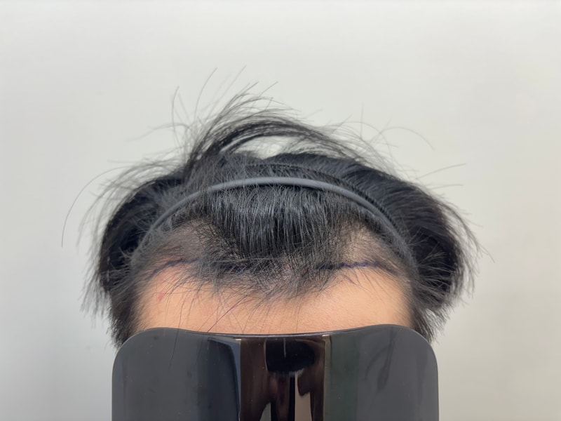모바른의원 비절개 2500모 2일차 후기