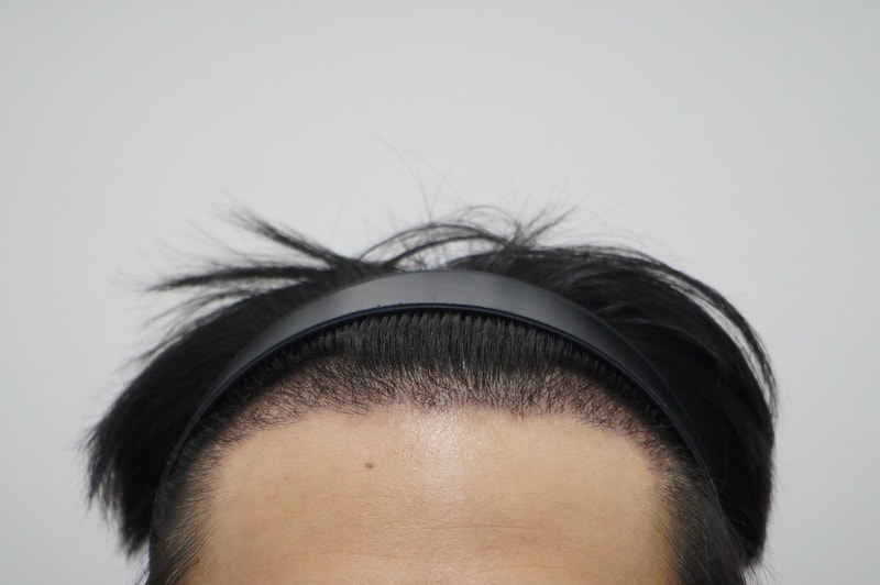 수술후 5주차.jpg