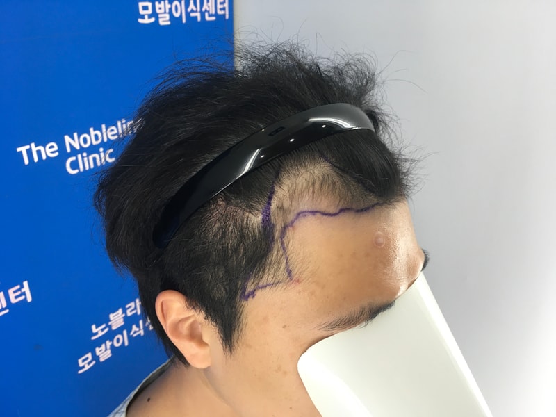 노블라인에서 수술하기를 정말 잘했습니다.