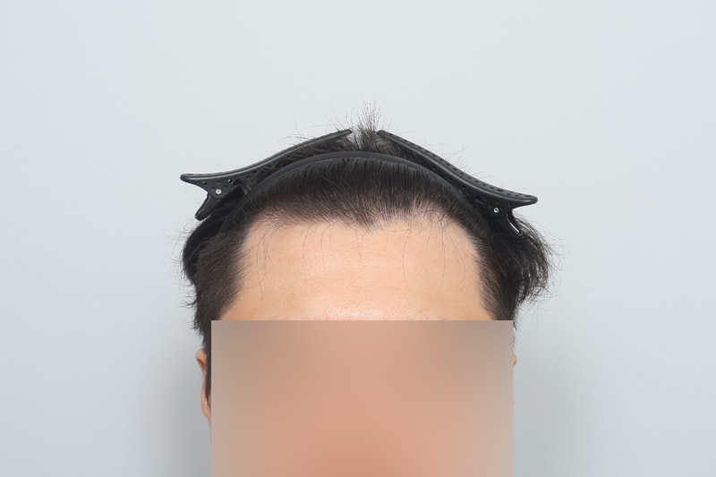 무삭발 비절개 모발이식 3400모 4개월차 모원성형외과 