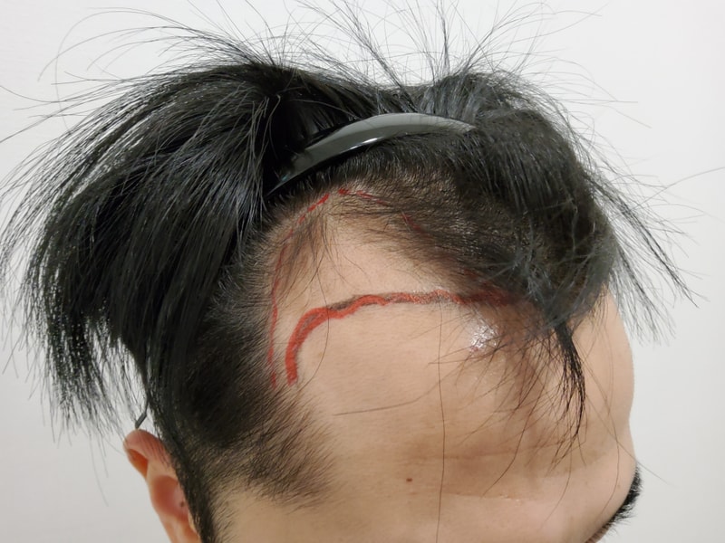1. 수술전_2.jpg
