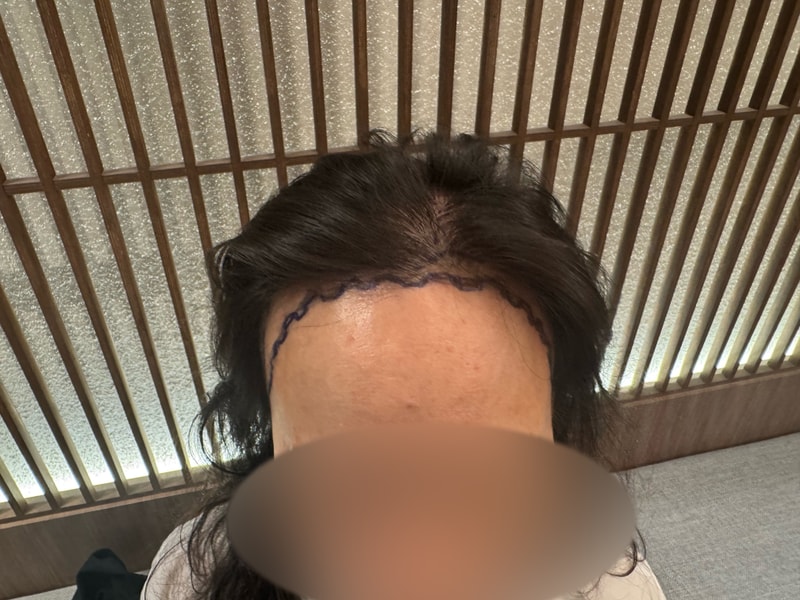 Shaved hairline Hair Transplant 3000 Mo 10th day shampoo before and after MO.1 plastic surgery Park Jong-ok.