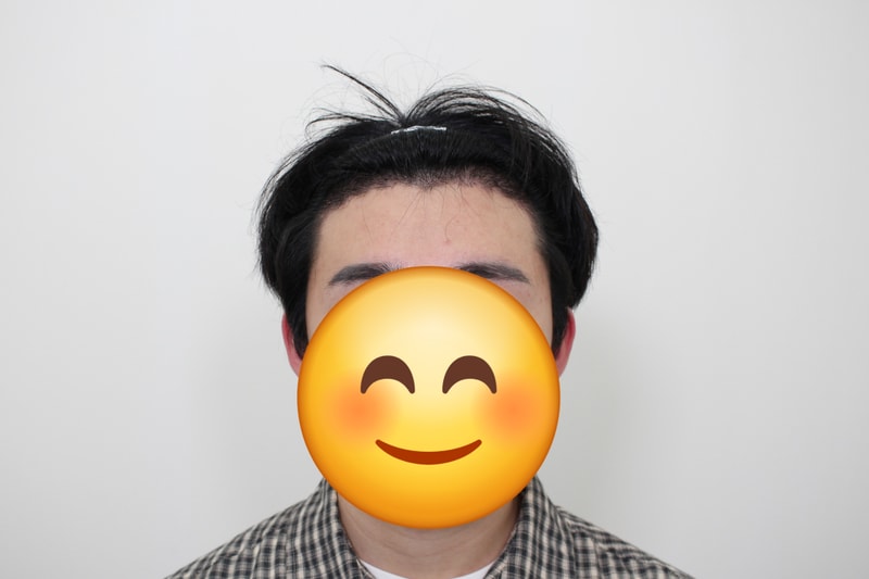 수술 17일 차 앞모습 2.jpg