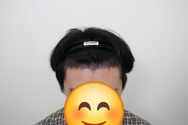 수술 17일 차 앞모습.jpg