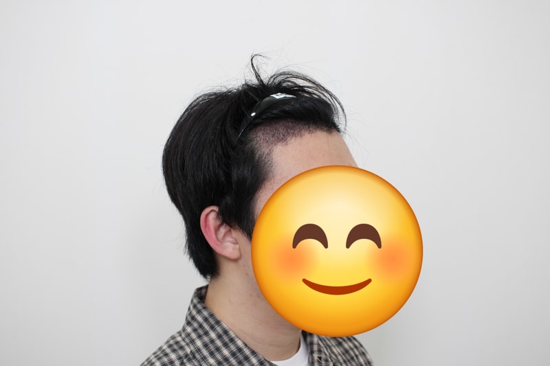 수술 17일 차 옆모습.jpg