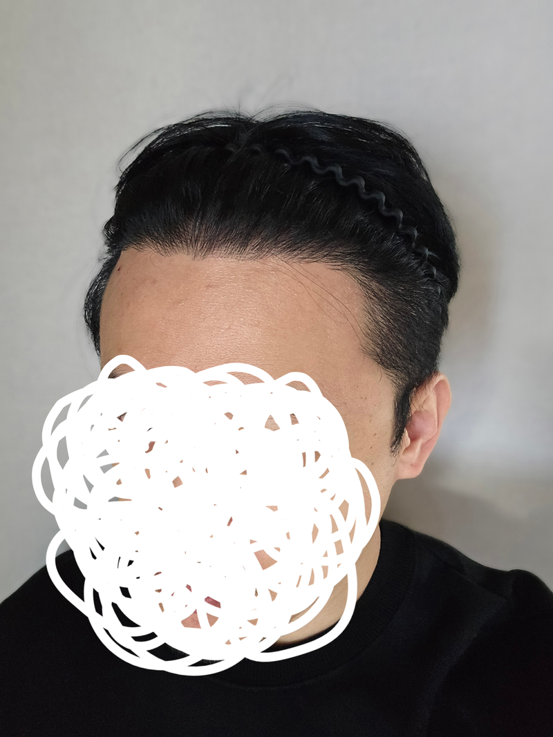 동탄헤어로의원 절개 4500모 9개월 경과 후기입니다.(셀카 포함)