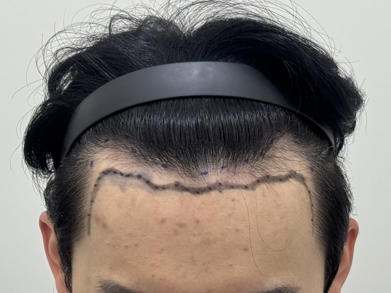 M자 탈모인 2800모 모발이식 2주차 후기