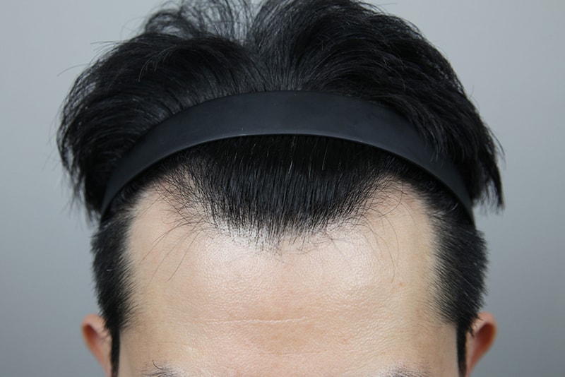M자 모발이식, 전문의 1인 원장 기준으로 고른 모나라 후기