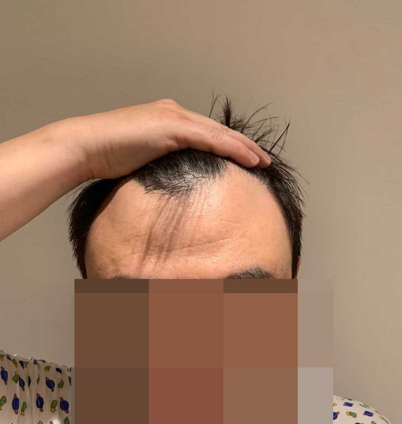 탈모상태어쩔ㅡㅡㅋ.jpg