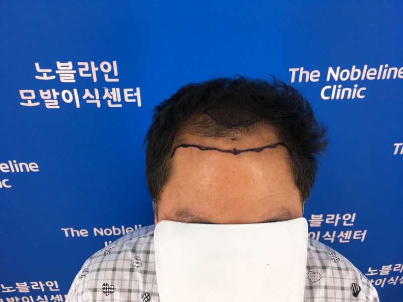 모발이식하지 4개월 머리가 조금씩 올라옵니다.