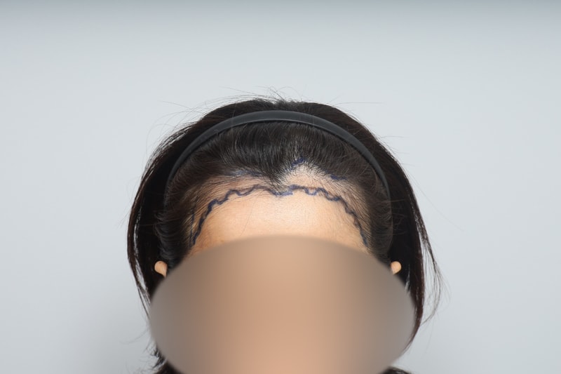수술전2.jpg