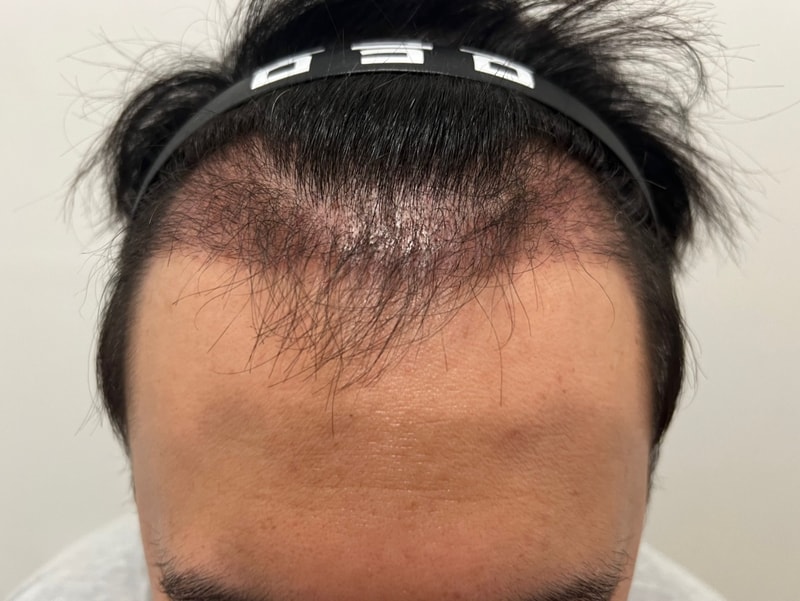 3. 수술후_3개월_1.jpg
