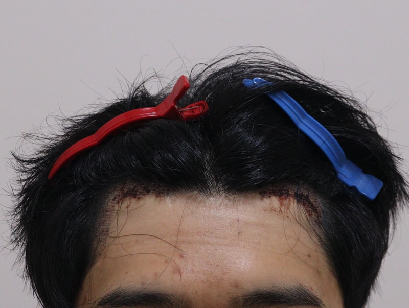 2. 수술후_1일_1.JPG
