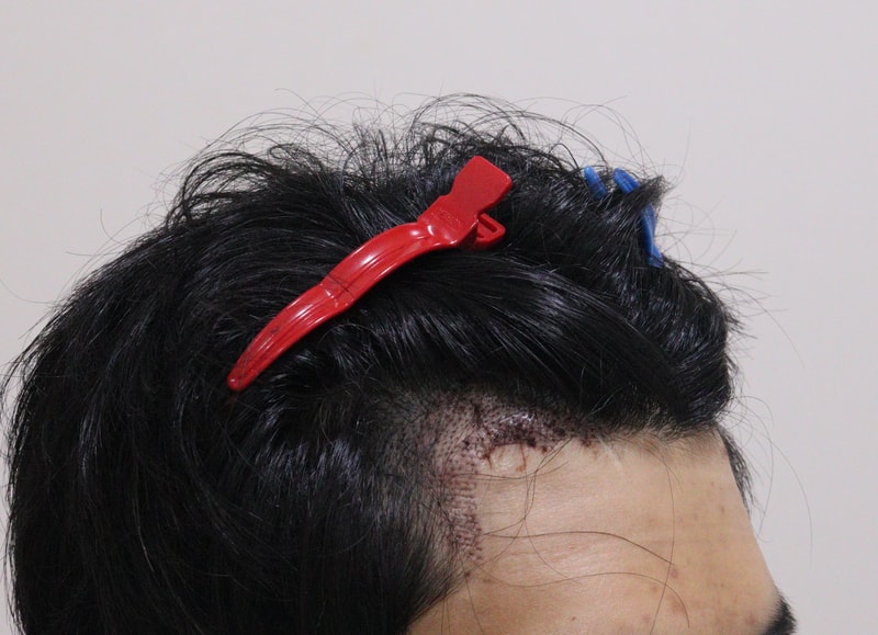 2. 수술후_1일_3.JPG