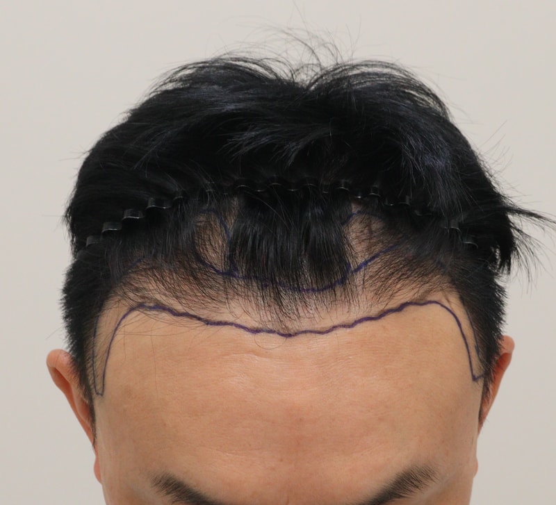 1. 수술전_2.JPG