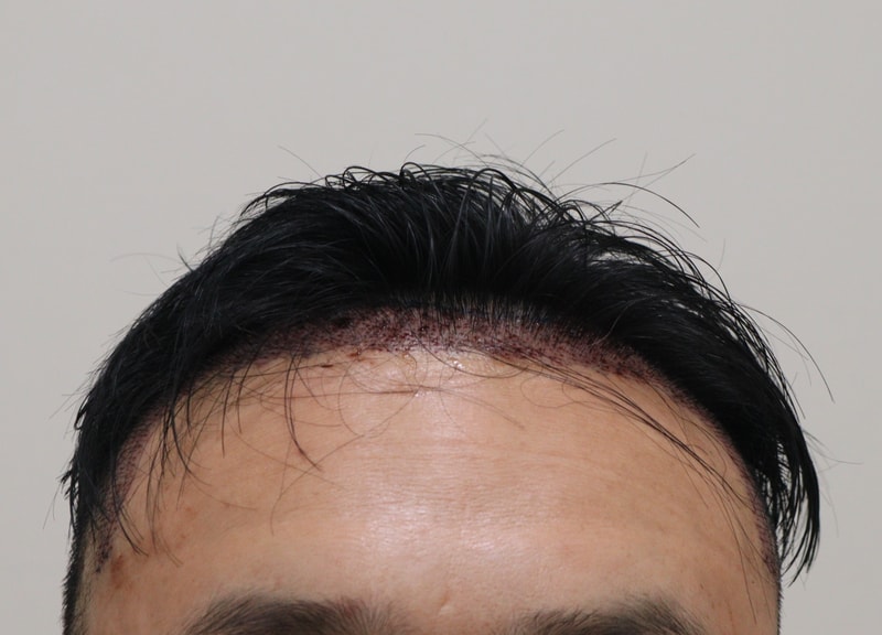 2. 수술후_1일_1.JPG