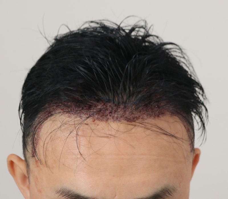 2. 수술후_1일_2.JPG